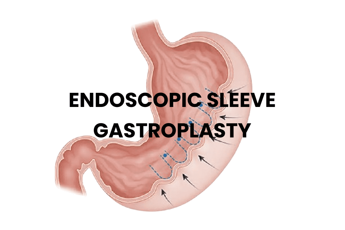 Endoscopic Sleeve Gastroplasty